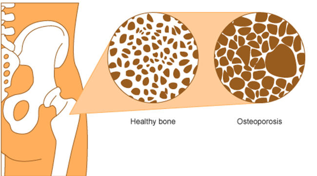 This figure compares healthy bone with bone affected by osteoporosis. It shows reduced bone density in the bone affected by osteoporosis compared with healthy bone.