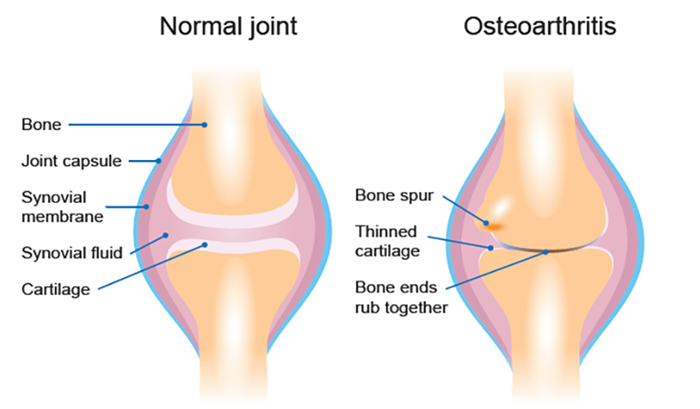 This image compares the anatomy of a healthy joint with a joint affected by osteoarthritis. The image shows bone spurs, thinned cartilage and bone ends that rub together in osteoarthritis compared with a normal joint.