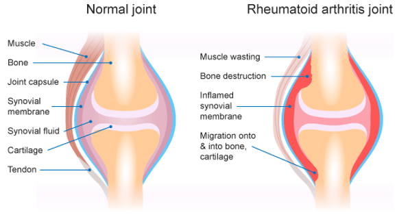 This figure shows the differences between the synovial membrane in a healthy joint and one with rheumatoid arthritis.